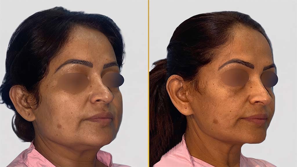 Face Lift before and after result - The Hair and Shape Clinic, Mumbai