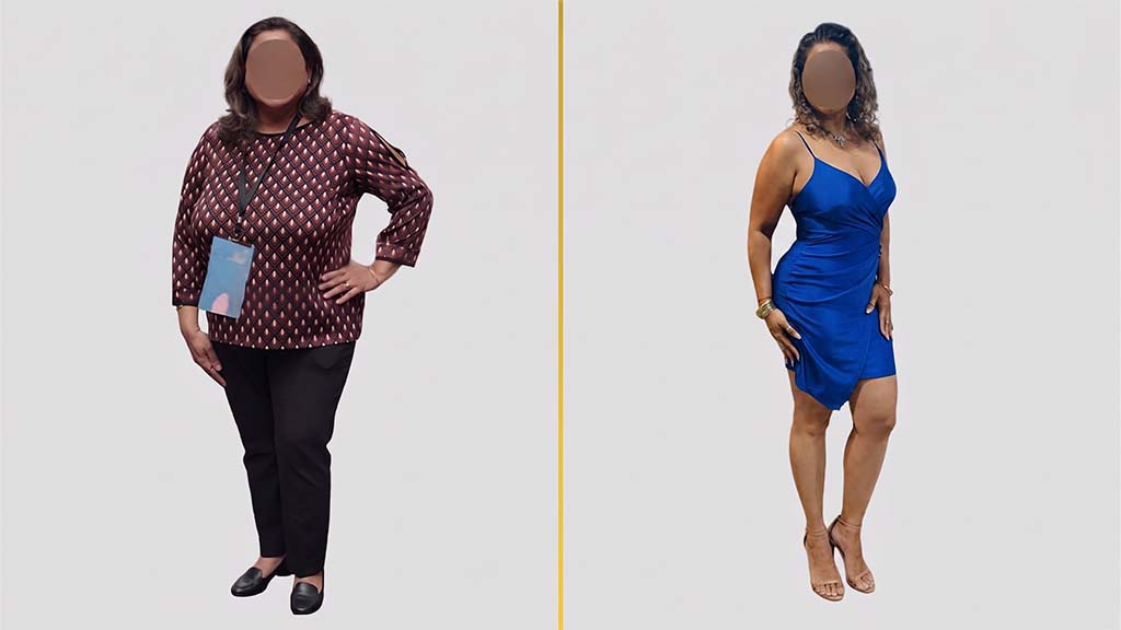 Mommy Makeover before and after result - The Hair and Shape Clinic, Mumbai