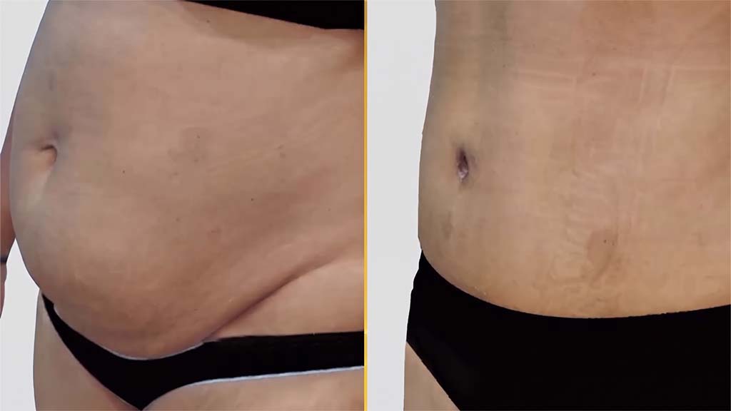 Mommy Makeover before and after result - The Hair and Shape Clinic, Mumbai