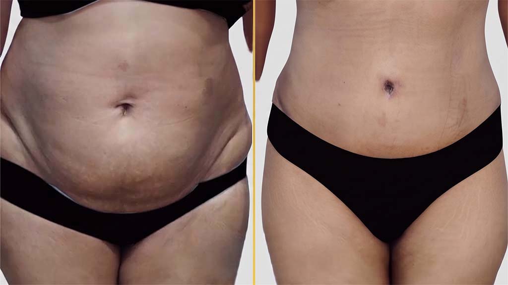 Mommy Makeover before and after result - The Hair and Shape Clinic, Mumbai