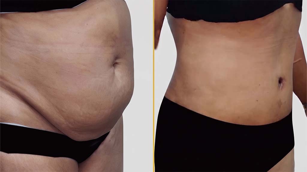 Mommy Makeover before and after result - The Hair and Shape Clinic, Mumbai