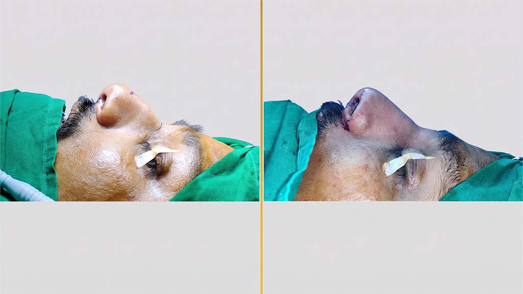 Rhinoplasty (Nose Surgery) before and after result - The Hair and Shape Clinic, Mumbai