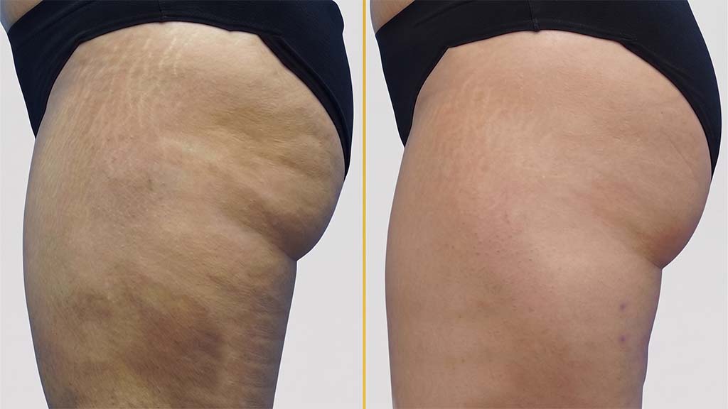Thigh Contouring before and after result - The Hair and Shape Clinic, Mumbai