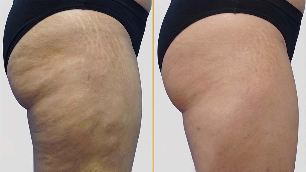 Thigh Contouring before and after result - The Hair and Shape Clinic, Mumbai