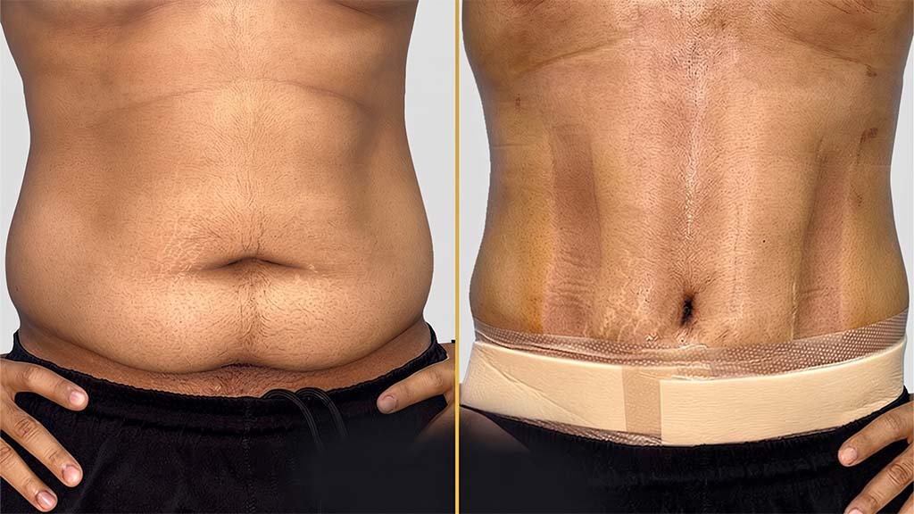 High Definition Liposuction before and after result - The Hair and Shape Clinic, Mumbai