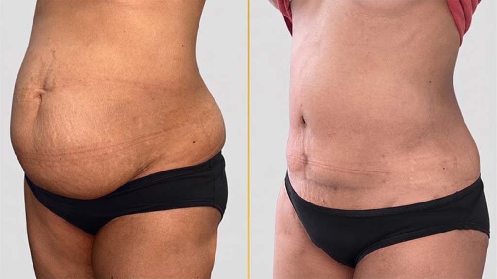 Tummy Tuck before and after result - The Hair and Shape Clinic, Mumbai