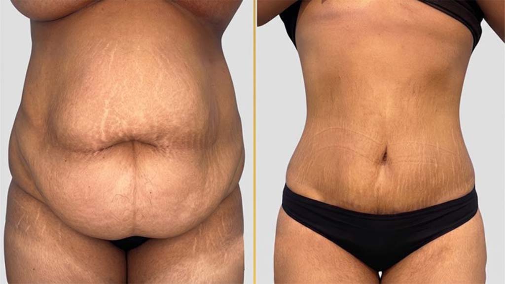 Tummy Tuck before and after result - The Hair and Shape Clinic, Mumbai