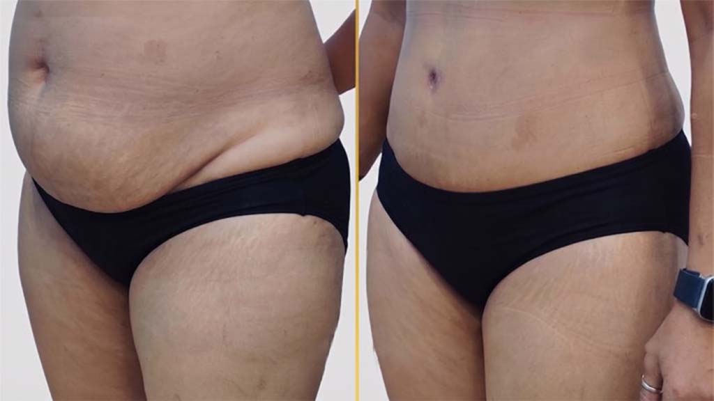 Tummy Tuck before and after result - The Hair and Shape Clinic, Mumbai