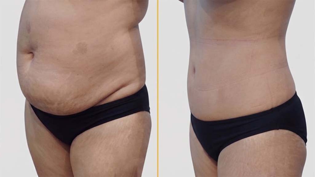 Tummy Tuck before and after result - The Hair and Shape Clinic, Mumbai