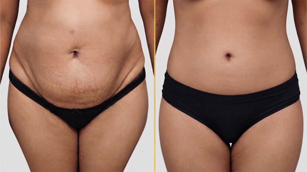 Tummy Tuck before and after result - The Hair and Shape Clinic, Mumbai