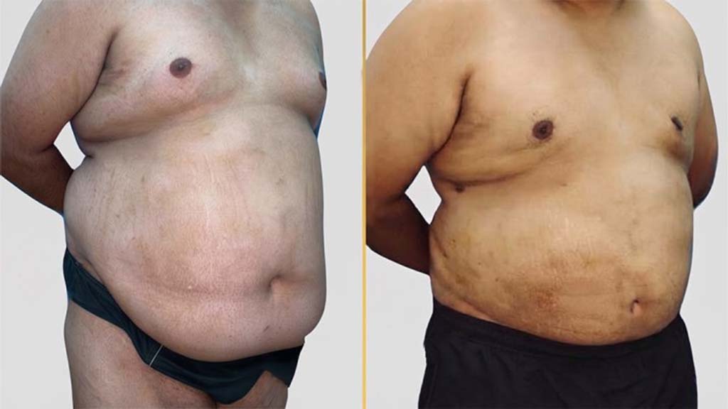 Tummy Tuck before and after result - The Hair and Shape Clinic, Mumbai