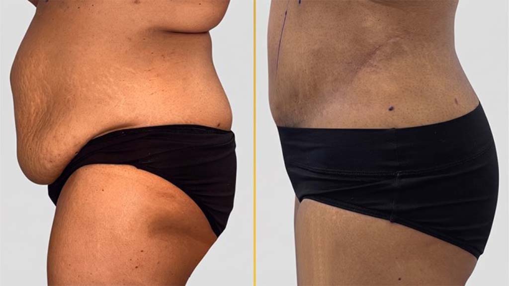 Tummy Tuck before and after result - The Hair and Shape Clinic, Mumbai