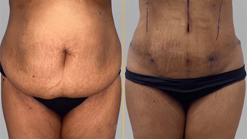 Tummy Tuck before and after result - The Hair and Shape Clinic, Mumbai