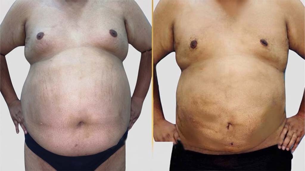 Tummy Tuck before and after result - The Hair and Shape Clinic, Mumbai