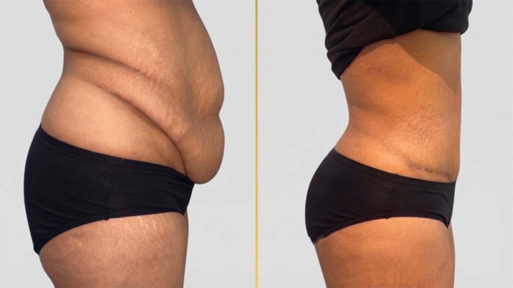 Tummy Tuck before and after result - The Hair and Shape Clinic, Mumbai