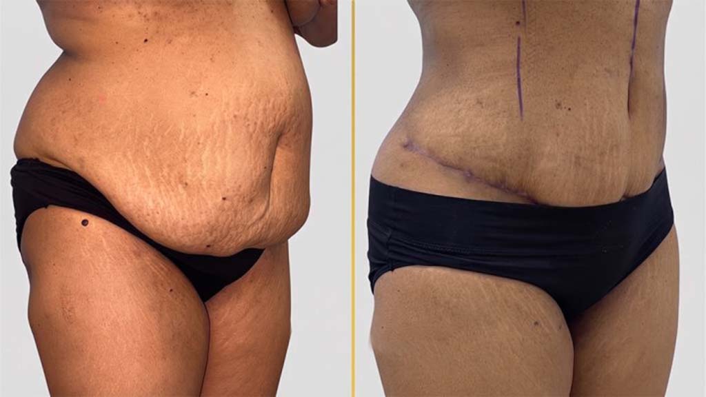 Tummy Tuck before and after result - The Hair and Shape Clinic, Mumbai