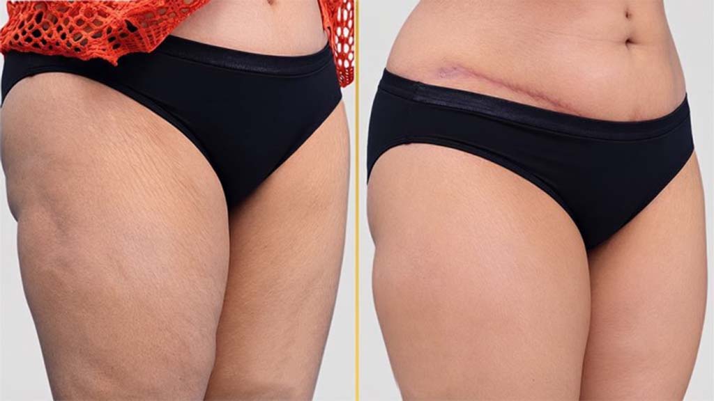 Tummy Tuck before and after result - The Hair and Shape Clinic, Mumbai