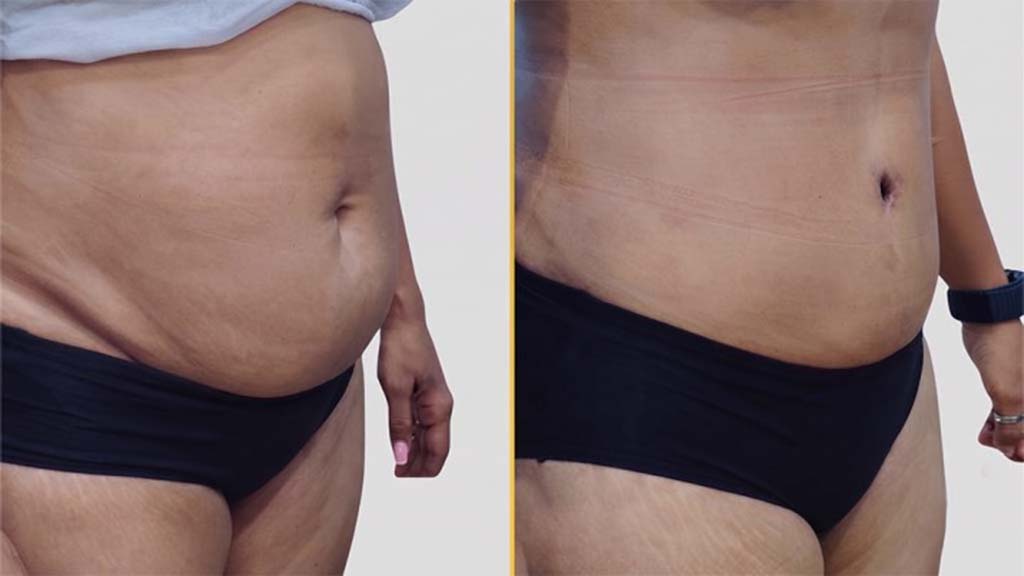 Tummy Tuck before and after result - The Hair and Shape Clinic, Mumbai