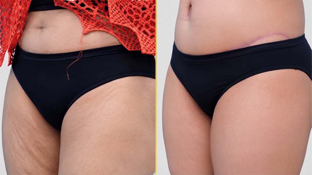Tummy Tuck before and after result - The Hair and Shape Clinic, Mumbai
