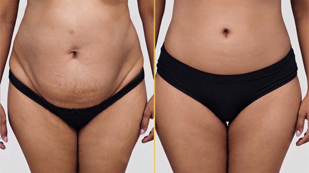 Tummy Tuck before and after result - The Hair and Shape Clinic, Mumbai