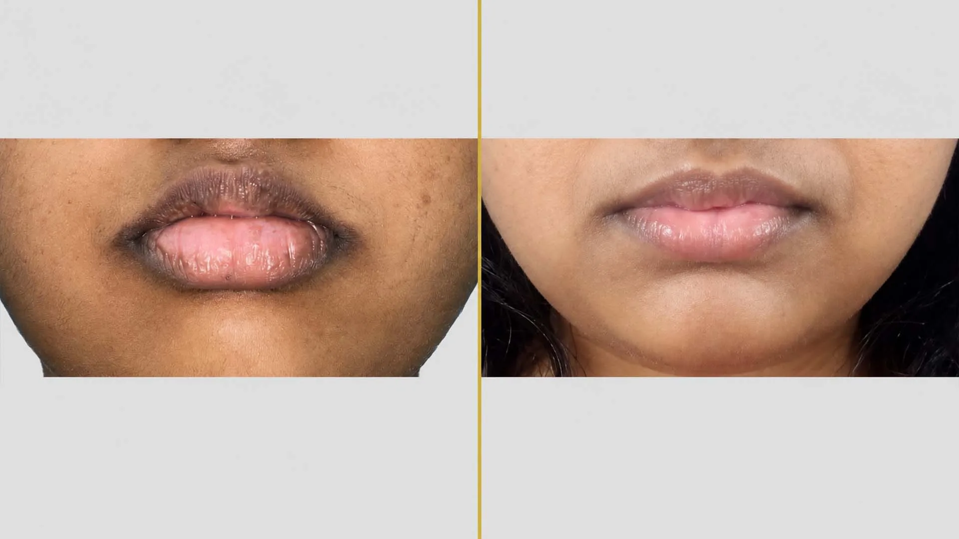 Lip Augmentation/Reduction before and after result - The Hair and Shape Clinic, Mumbai