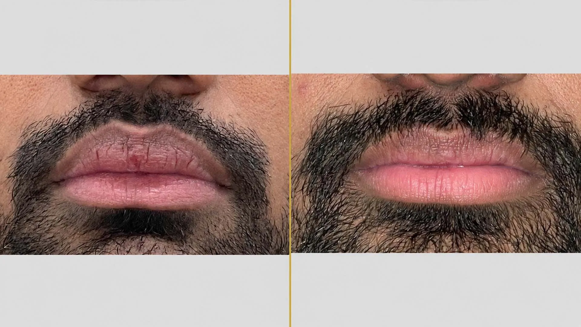 Lip Augmentation/Reduction before and after result - The Hair and Shape Clinic, Mumbai