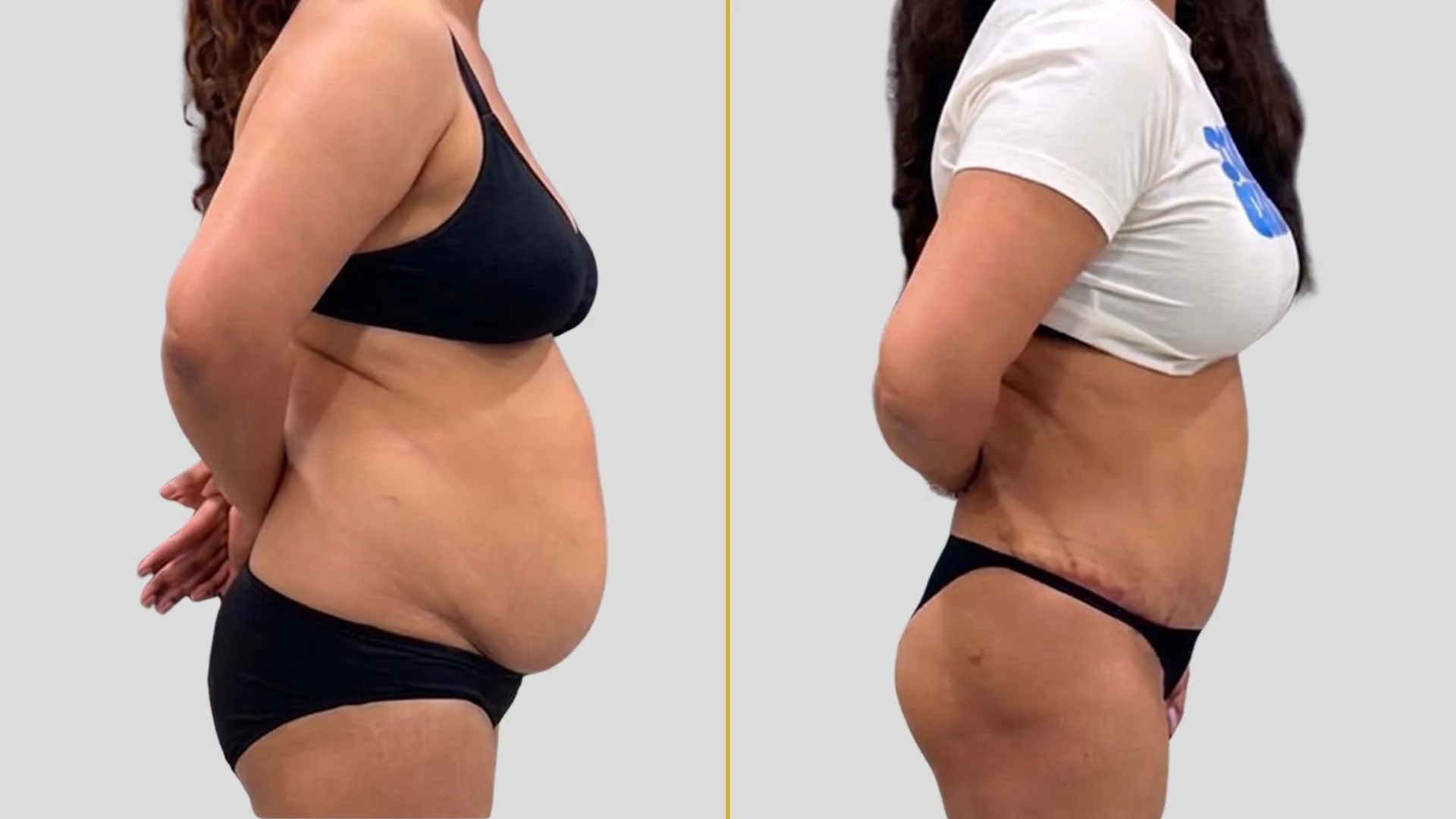 Liposuction before and after result - The Hair and Shape Clinic, Mumbai