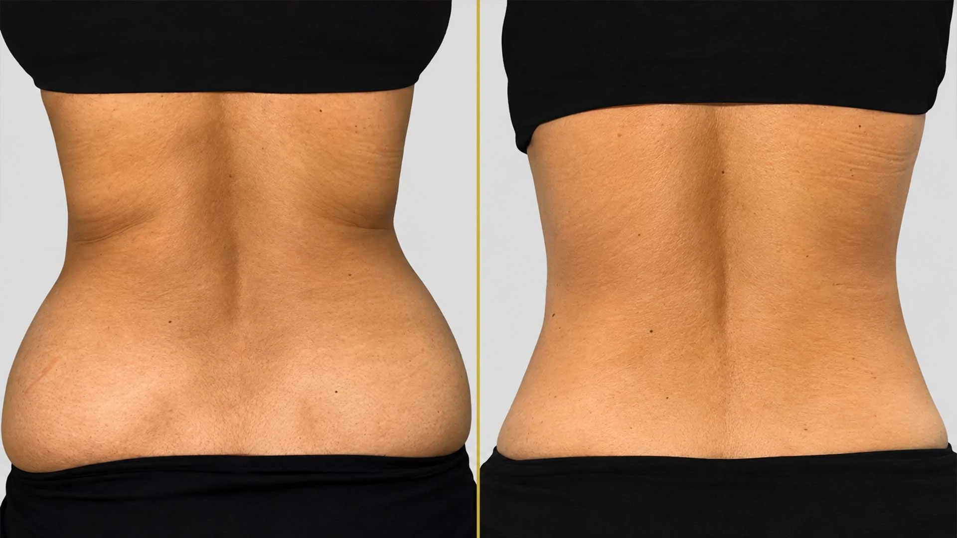 Liposuction before and after result - The Hair and Shape Clinic, Mumbai