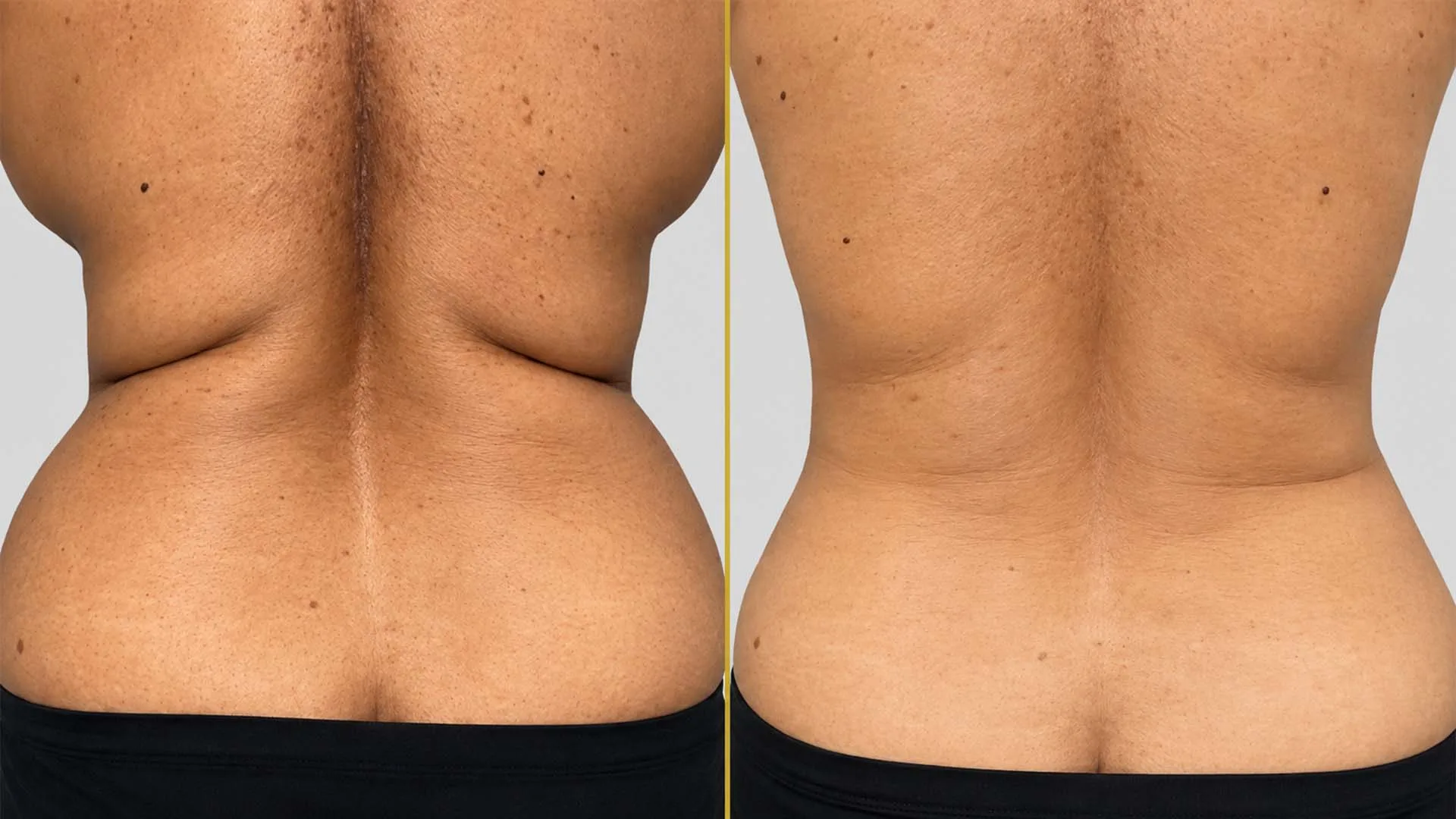 Liposuction before and after result - The Hair and Shape Clinic, Mumbai
