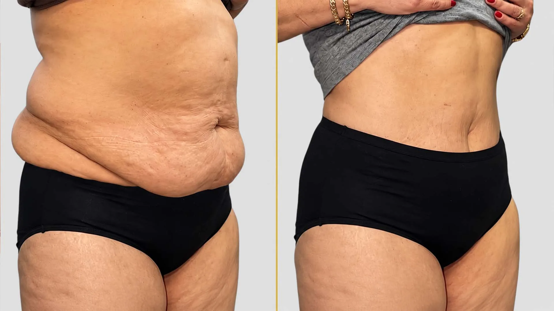 Tummy Tuck before and after result - The Hair and Shape Clinic, Mumbai
