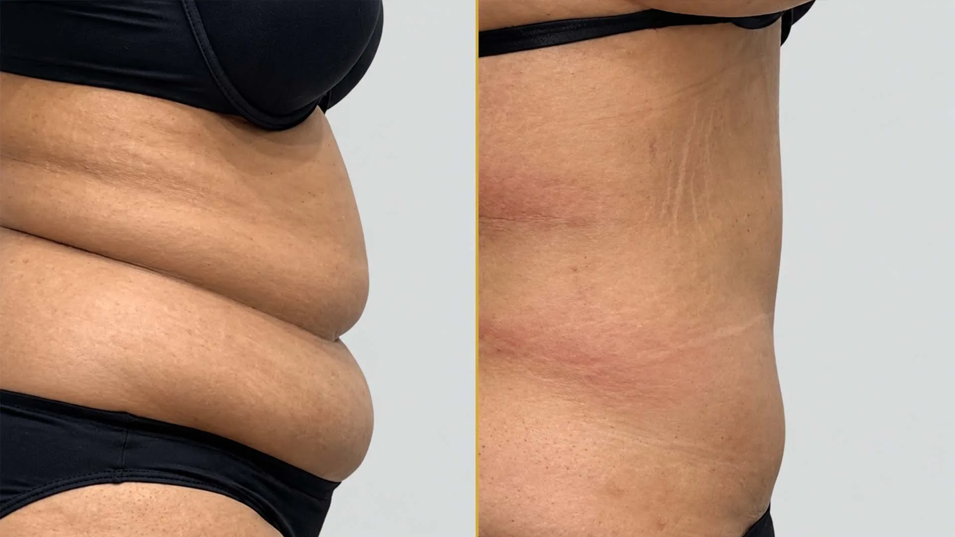 Tummy Tuck before and after result - The Hair and Shape Clinic, Mumbai