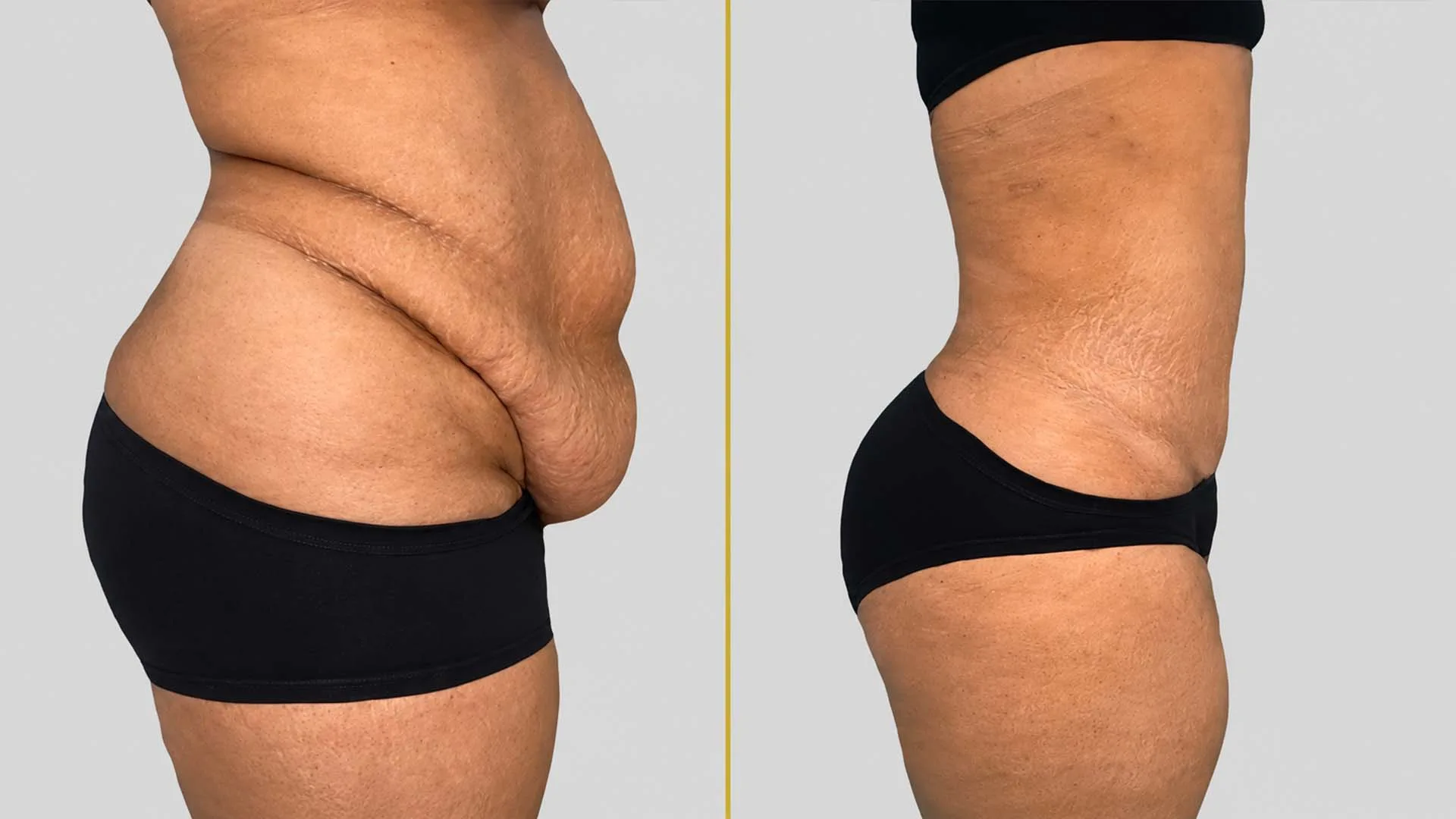 Tummy Tuck before and after result - The Hair and Shape Clinic, Mumbai