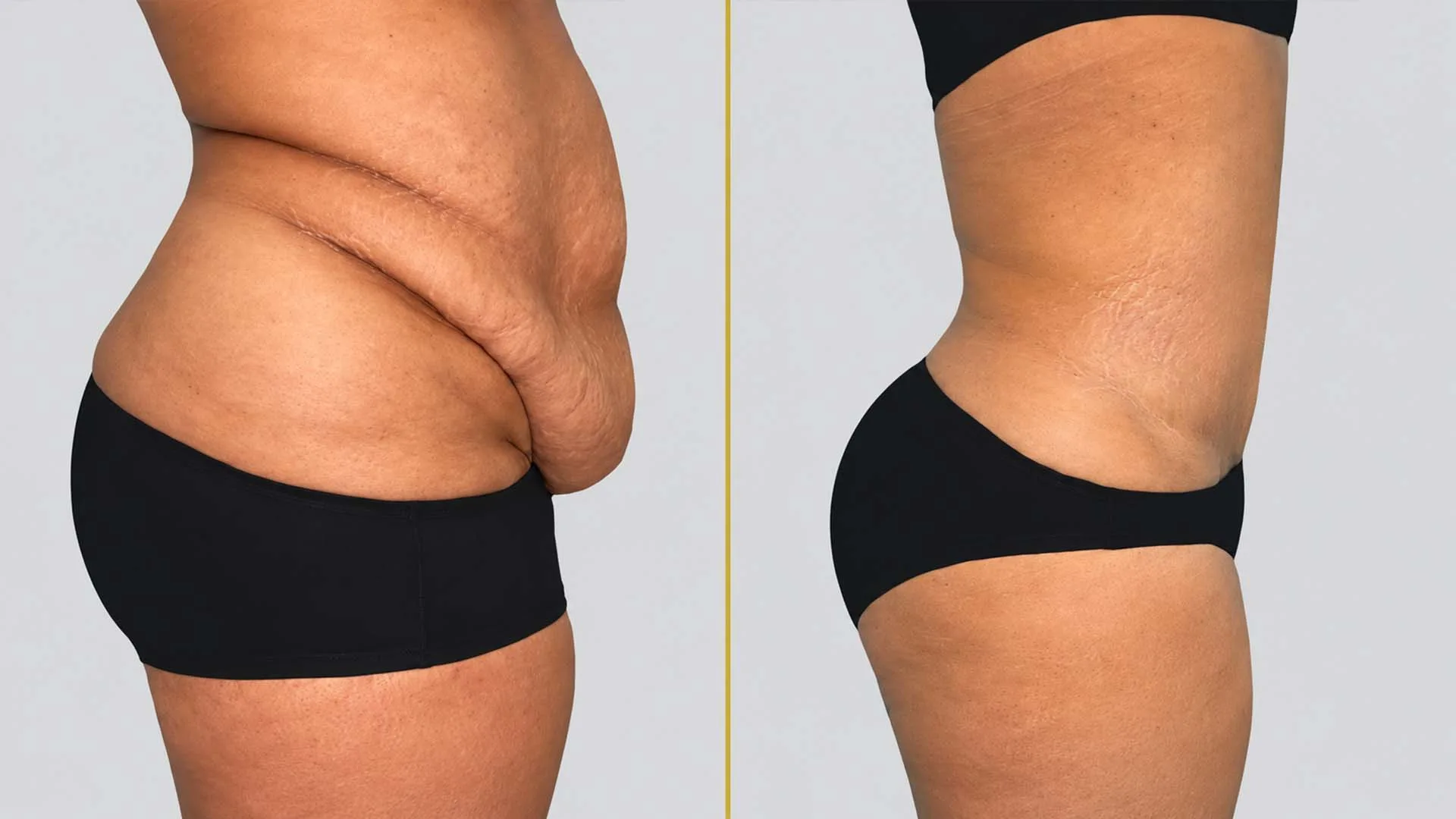 Tummy Tuck before and after result - The Hair and Shape Clinic, Mumbai
