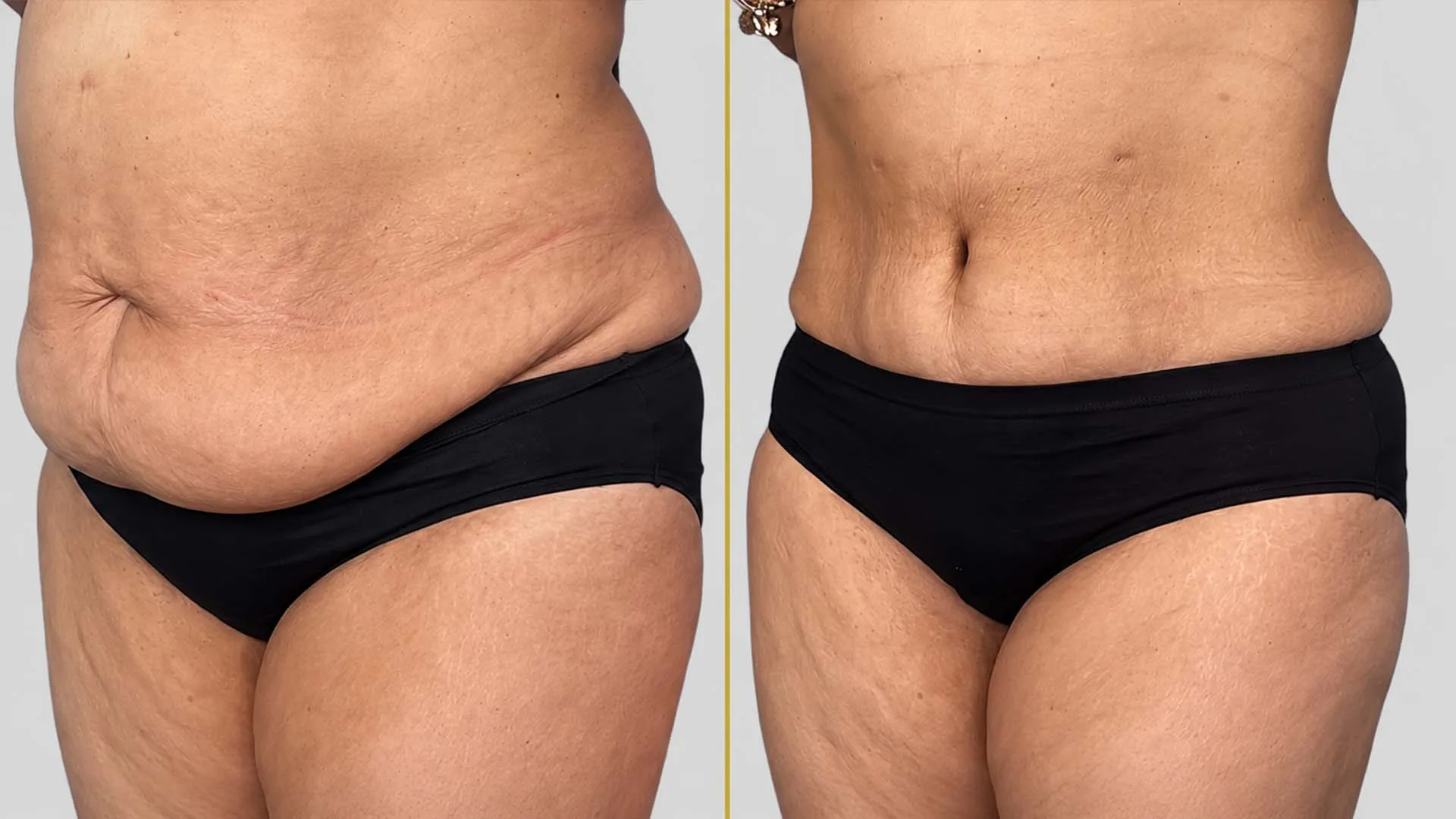Tummy Tuck before and after result - The Hair and Shape Clinic, Mumbai