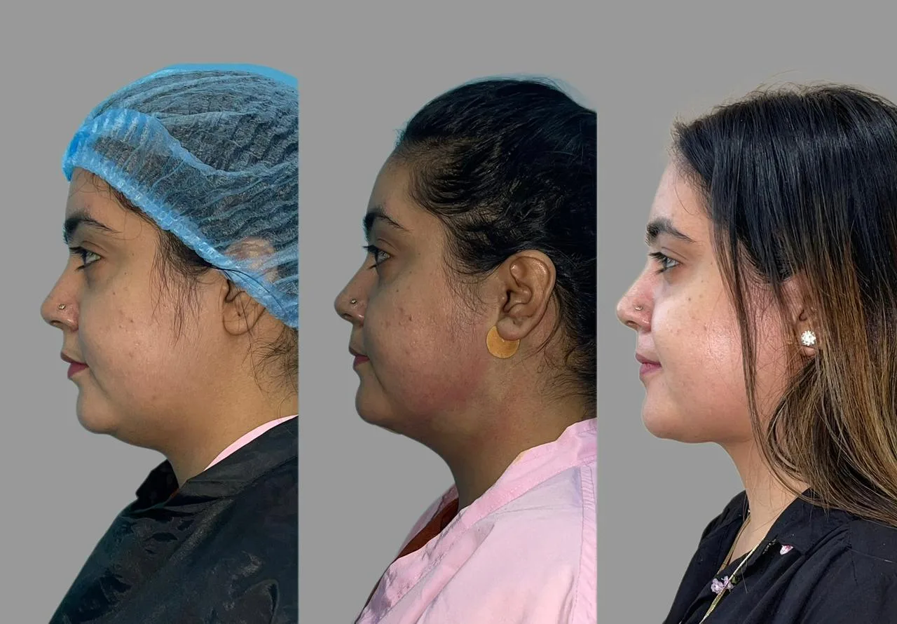 A three-panel clinical profile comparison showing a female patient before double chin liposuction, immediately after the laser micro-lift procedure, and her final sharp jawline results two months later."