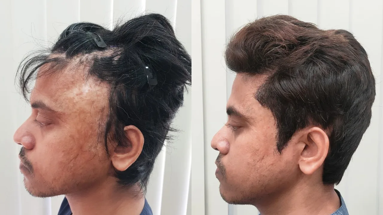 "Before and after side profile comparison of male temporal hairline restoration achieved with 3000 grafts by Dr. Umang Kothari in Mumbai.