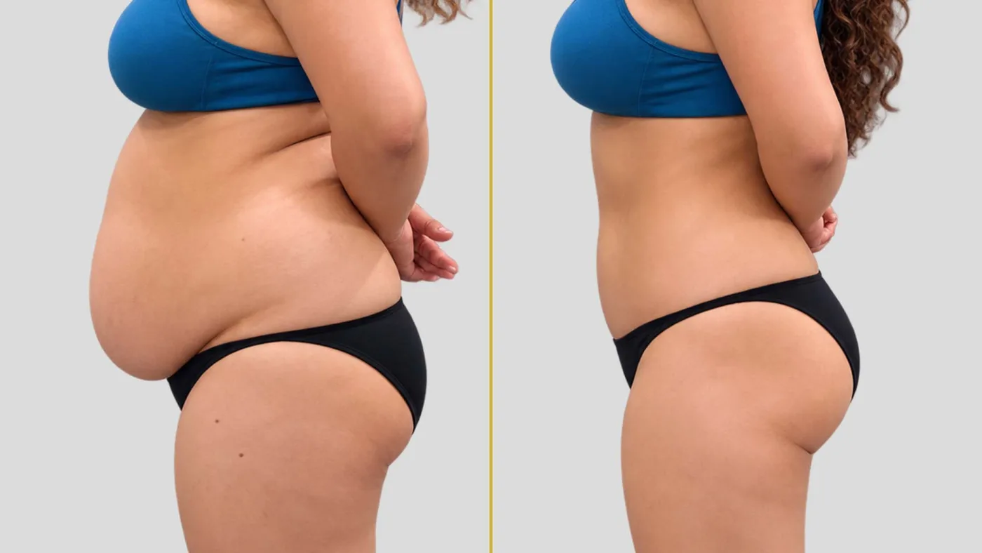 "Clinical before and after side profile of a female patient showing the elimination of loose abdominal skin and a flattened core after a successful tummy tuck surgery in Mumbai.